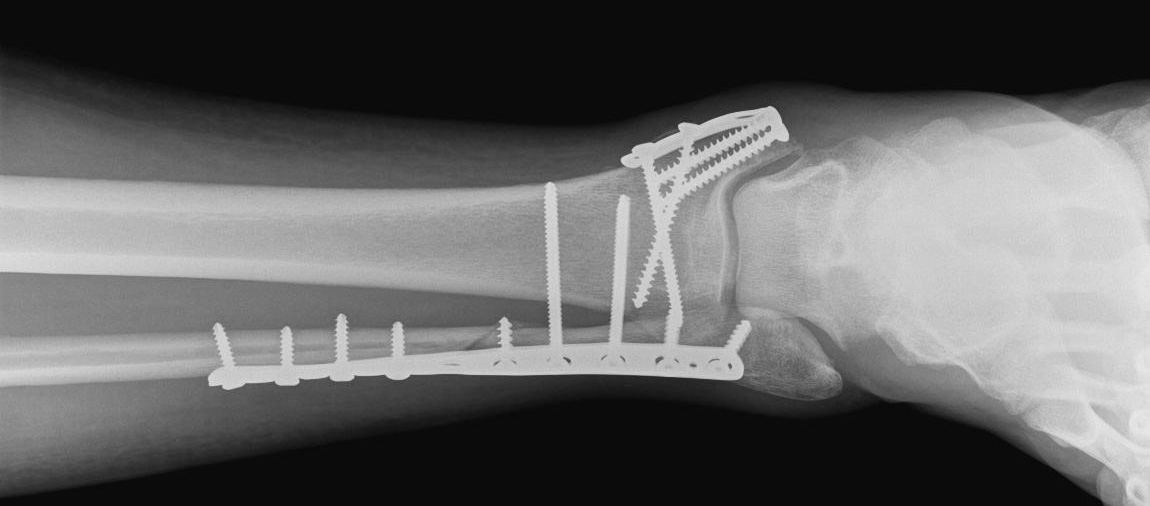 orif tib fib fracture hardware