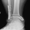 Broken ankle ( Open reduction and internal fixation )